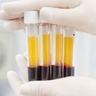 У 90 % пациентов, получивших лечение иммунной плазмой, улучшилось состояние 